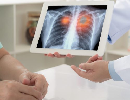 Saúde Câncer de pulmão também pode atingir não fumantes